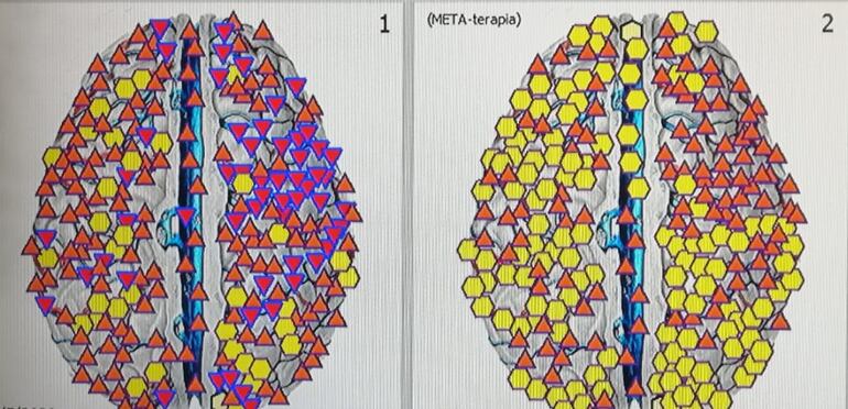 Bioplasma. La imagen muestra a la izquierda una porción del cuerpo luego del escaneo, y a la derecha luego de aplicar una primera limpieza, con una notable mejoría.