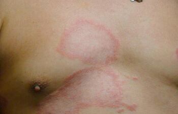 La detección temprana ayuda a que la lepra sea curable.