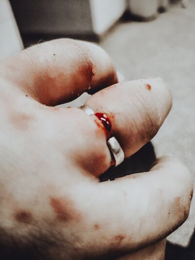 La joven tenía anillos atorados y no había material quirúrgico para retirarlos.