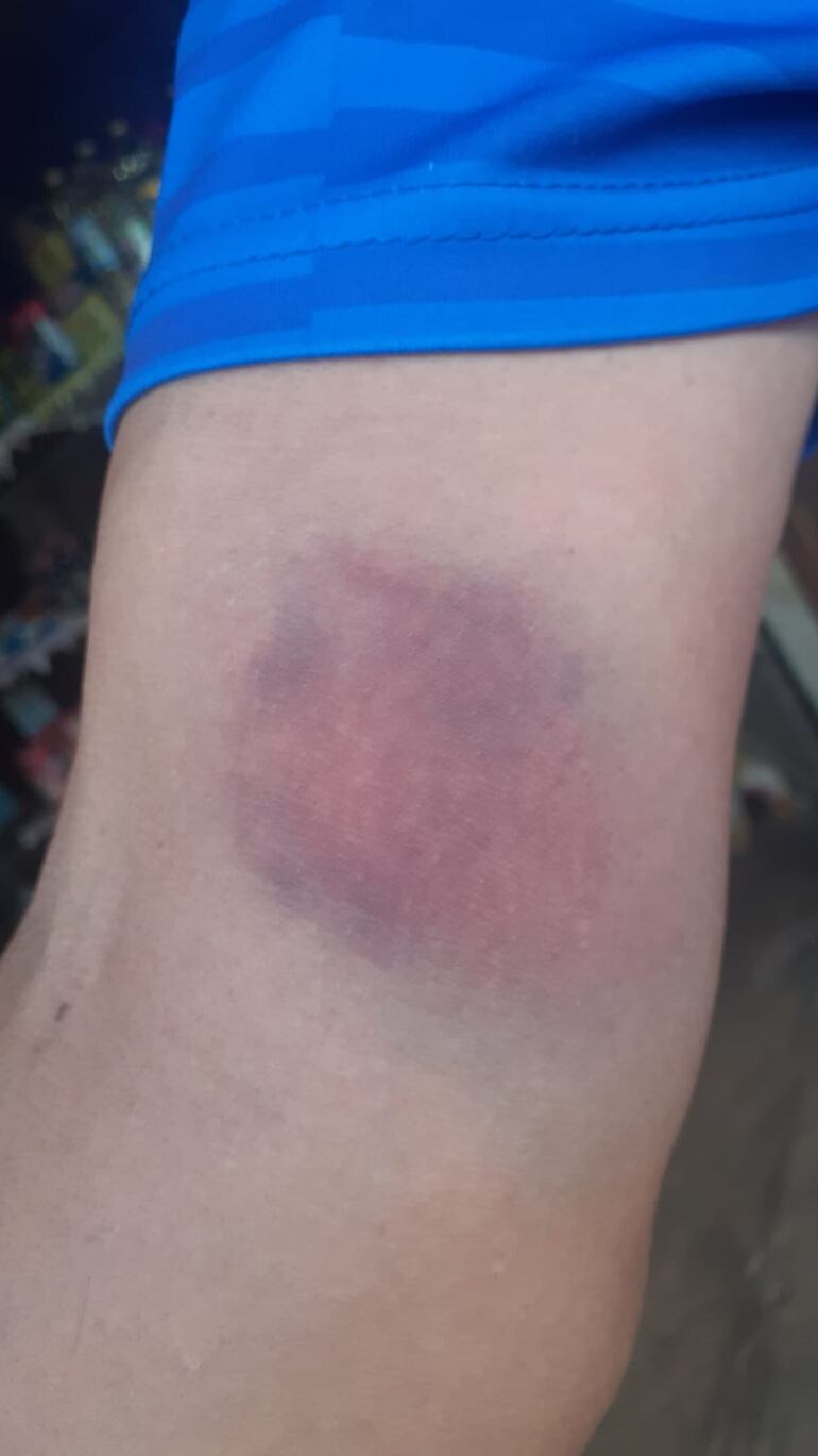 Alipio Sosa mostró la secuela del golpe que recibió