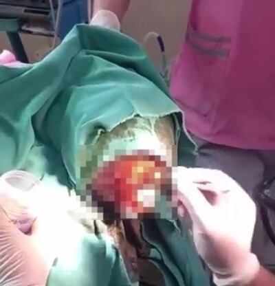 Los médicos tuvieron que sedar a la niña para extirparle los gusanos de la cabeza.