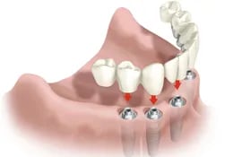 en-la-actualidad-existen-diversas-tecnicas-que-ayudan-a-una-mejor-estetica-dental-los-implantes-han-revolucionado-con-sus-soluciones-a-la-medida-y-e-215023000000-1378072.jpg