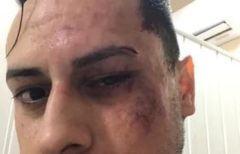 Richar Fernández Chaparro sufrió serios golpes en el rostro.