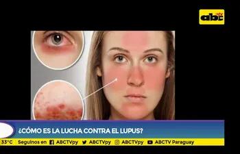 Cómo es la lucha contra el lupus