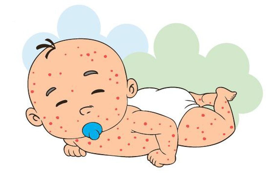 El Sarampion Escolar Abc Color