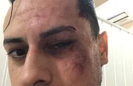 Richar Fernández Chaparro sufrió serios golpes en el rostro.