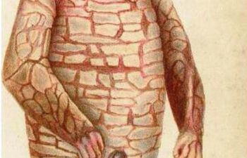 Ictiosis Arlequin En Abc Color