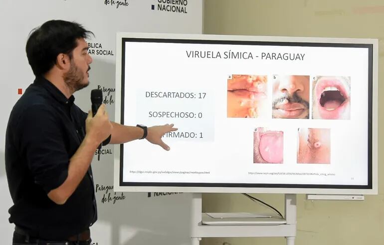 Hay un solo caso confirmado de la viruela del mono en el Paraguay, según informó el director de Vigilancia, Dr. Guillermo Sequera.
