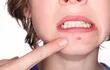 no-se-conocen-las-causas-del-acne-sus-manifestaciones-se-observan-en-el-rostro-y-espalda-e-incluyen-lesiones-seborreicas-eritomatopapulosas-pustulo-220729000000-1774486.jpg
